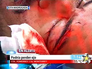 Podría perder ojo por botellazo (FUERTES IMAGENES)