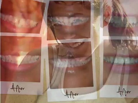 Local Dentist Glenwood Smiles | Invisalign Braces