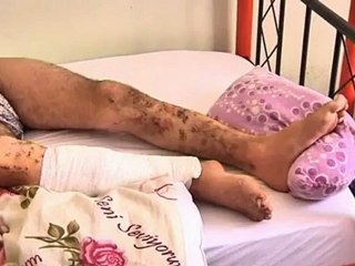 Wounded Syrians treated at makeshift hospital