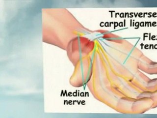 Carpal Tunnel
