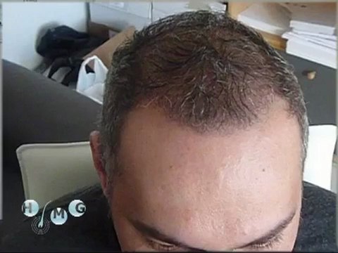 Kiváló Hajbeültetés a HIMG Hajklinikán