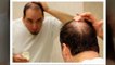 Natural Hair loss treatment for men - Provillus Reviews