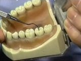 Dental Sealants - Long Island Dentist