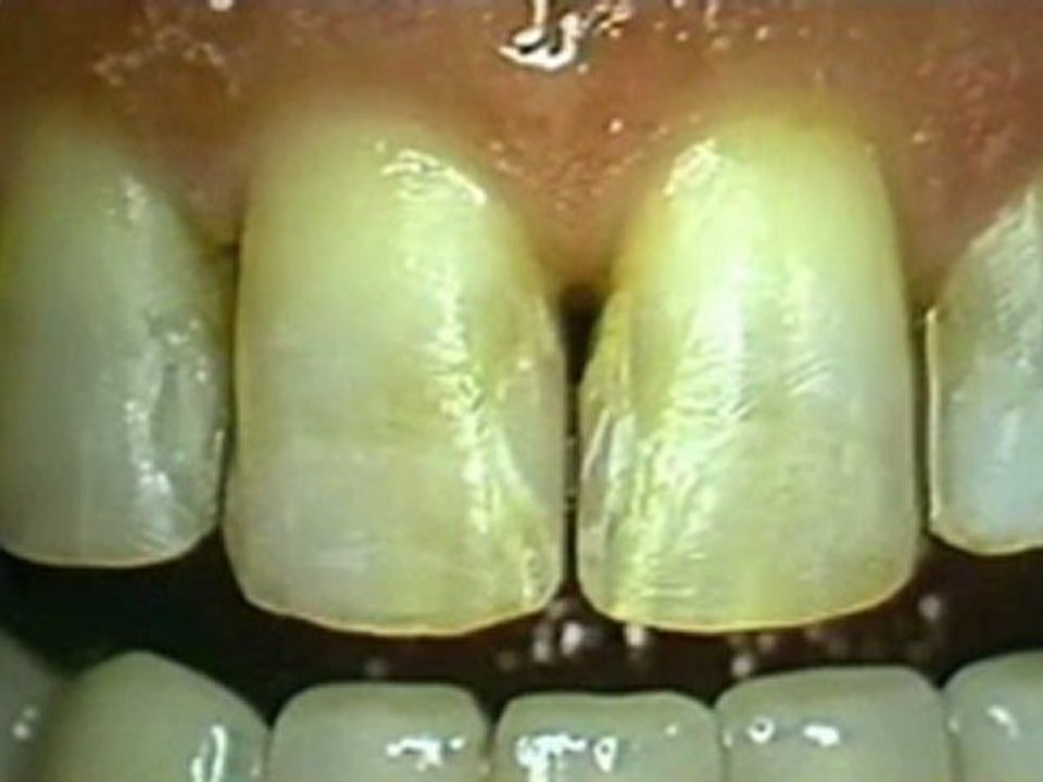 Porcelain veneers - Long Island Dentist