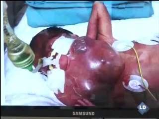 Extirpan con éxito un tumor de 168 gramos a un feto fuera del útero materno