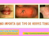 herpes zoster contagio - herpes bucal - que es herpes