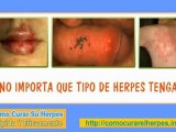 tipos de herpes - herpes zoster tratamiento - herpes oral