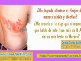 herpes labial contagio - herpes zóster - el herpes
