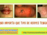herpes simplex tipo 1 - herpes simple 1 - herpes simple