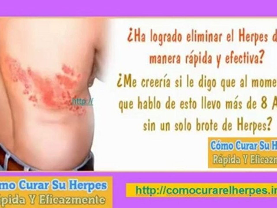 Herpes zoster sintomas - herpes tipo 2 - herpes circinado