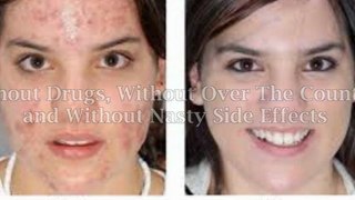 Most effective acne treatments | most effective acne treatments