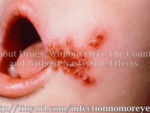 Yeast infection treatments | yeast infection treatments