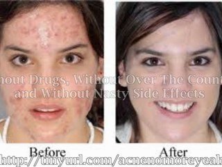 The most effective acne treatment