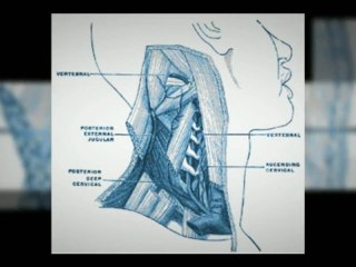 ccsvi