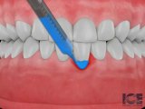 Washington DC Periodontist Patient Education - Connective Tissue Graft, Gum Graft, Bone Graft