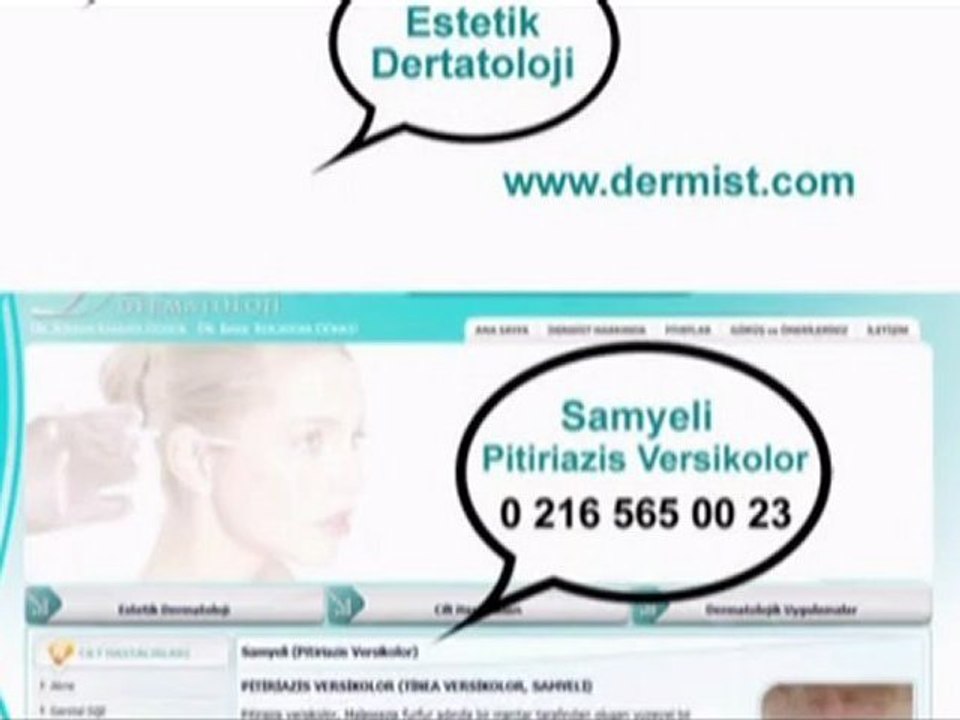 Samyeli Pitiriazis Versikolor / www.dermist.com