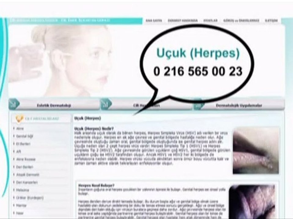 Uçuk Herpes / www.dermist.com