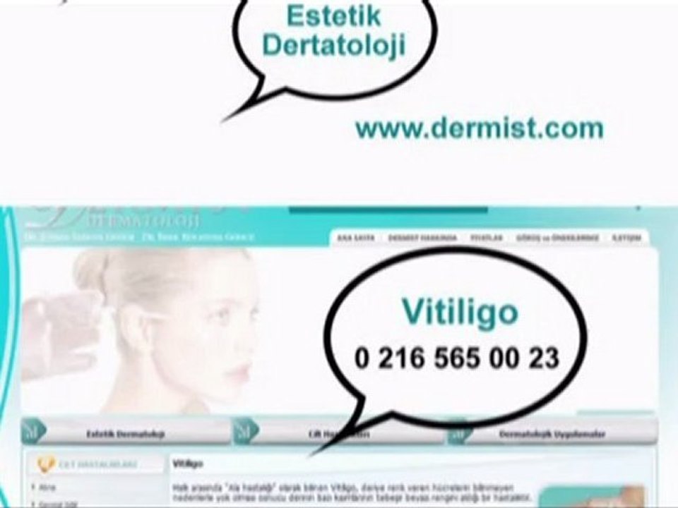 Vitiligo / www.dermist.com