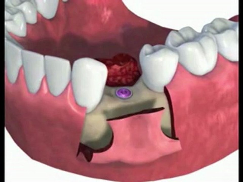 Dental Implant Placement Procedure