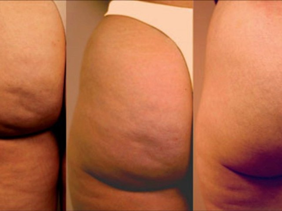 CELULITIS NUNCA MAS