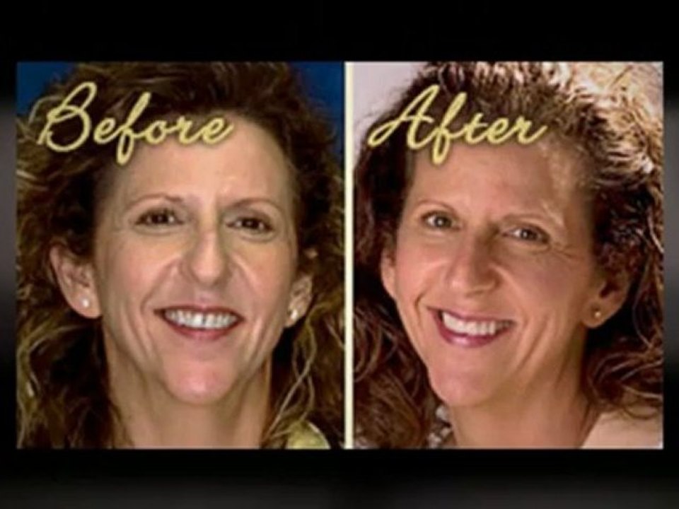 Invisalign