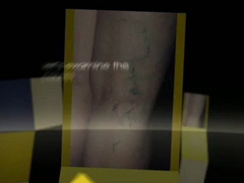 What Are Varicose Veins and How They Are Treated - Removing varicose veins