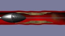 rotablator 3D