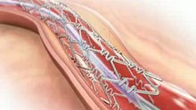 Coronary_Stent_Animation