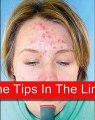 how to get rid of acne fast without buying anything
