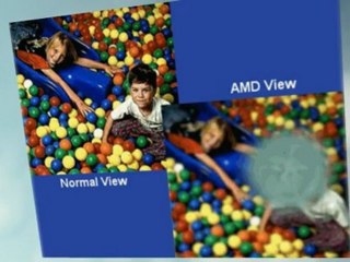 Sun Injury Can Cause Eye Disorders