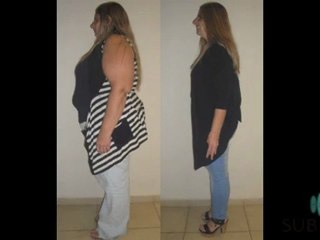 Cirugia Bariatrica: Testimonios
