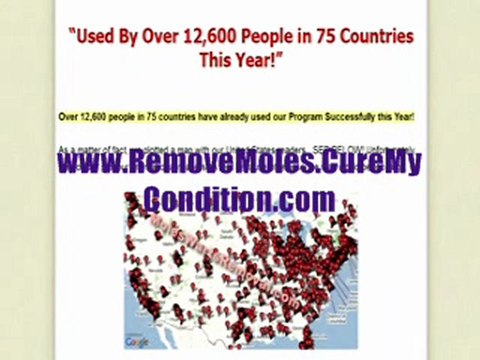 How To Remove Warts, Skin Tags And Moles By Yourself - Follow These Step By Step Instructions At Home