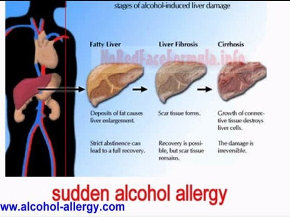 SUDDEN ALCHOL ALLERGY