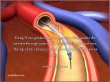 Angioplasty And Stenting - Does Angioplasty And Stenting Work?