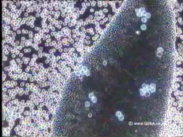 Radiation Increased Cancer Risk (Radiation Meters) Radiation Increased Cancer Risk