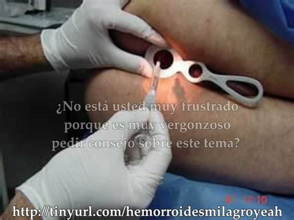 Como curar hemorroides sangrantes y eliminarlas en 48 horas