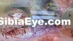 Cataract Eye Surgery Boynton, Boynton Beach Cataracts, Boynton Eye Care