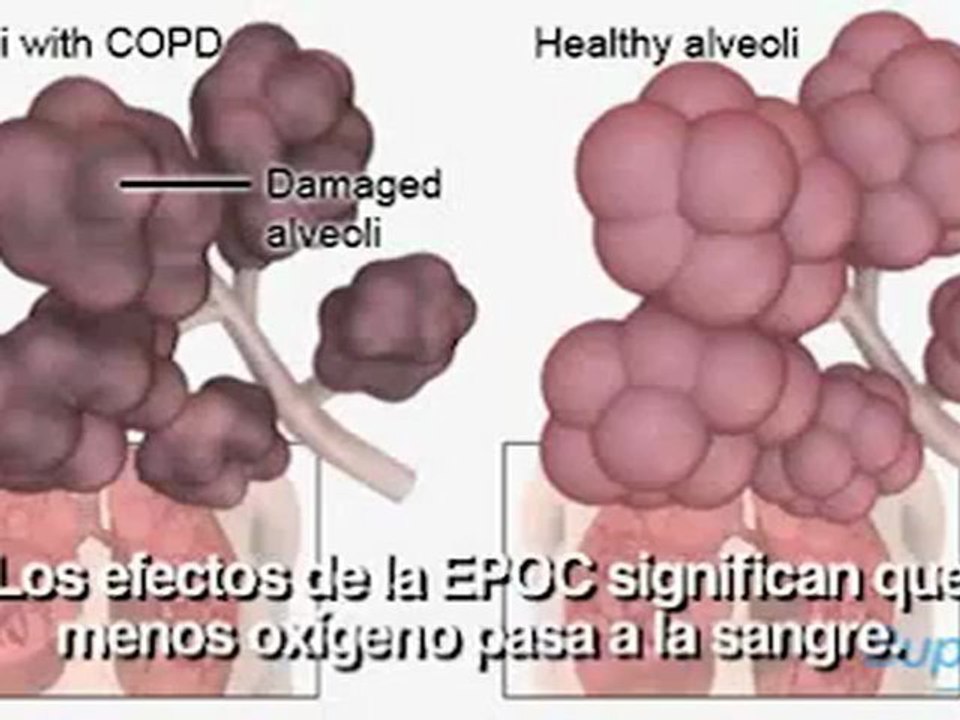 Enfermedad pulmonar obstructiva crónica EPOC