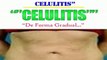 Como Eliminar la Celulitis de las Piernas-Celulitis Tratamiento Casero