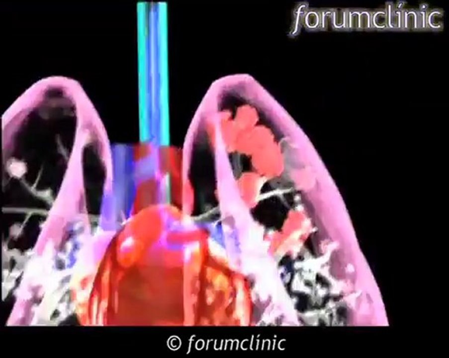 EPOC: el Enfisema pulmonar