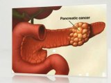 Pancreatic Cancer Statistics Four Stats You Should Know