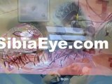 Eye Exams Lake Worth, Cataract Surgery Lake Worth, Optometrists Lake Worth, Eye Doctor Lake Worth