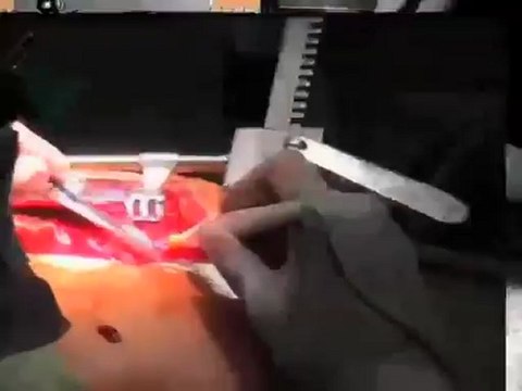 Coronary Artery Bypass Graft - CABG (Understanding Disease_ Cardiovascular Medicine)