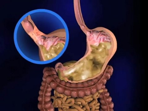 Gastro-Esophageal Reflux Disease (Understanding Disease_ Gastroenterology and Urology)