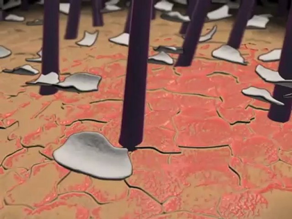 Dandruff (Understanding Disease_ Dermatology)