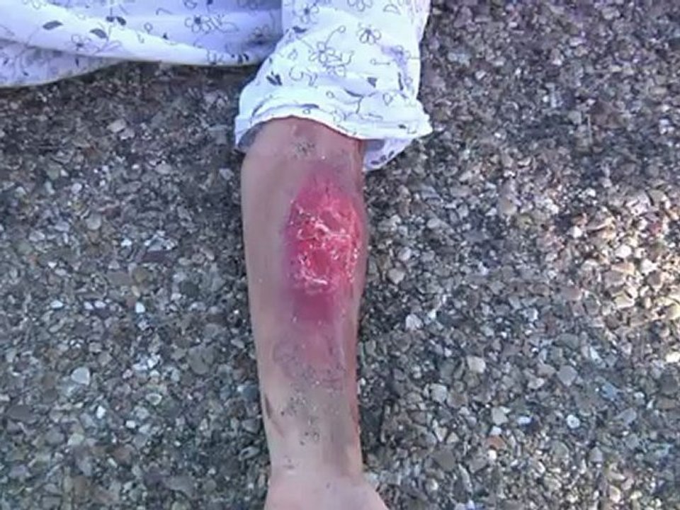 Conducción segura de motocicletas: Lesiones y quemaduras