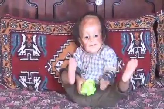 Bir yaşında yüz nakli istiyorlar