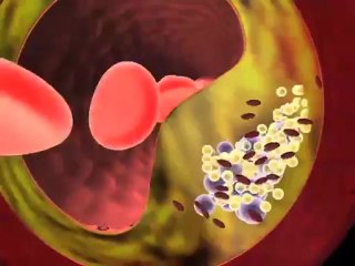 Dyslipidemia (Understanding Disease_ Cardiovascular Medicine)