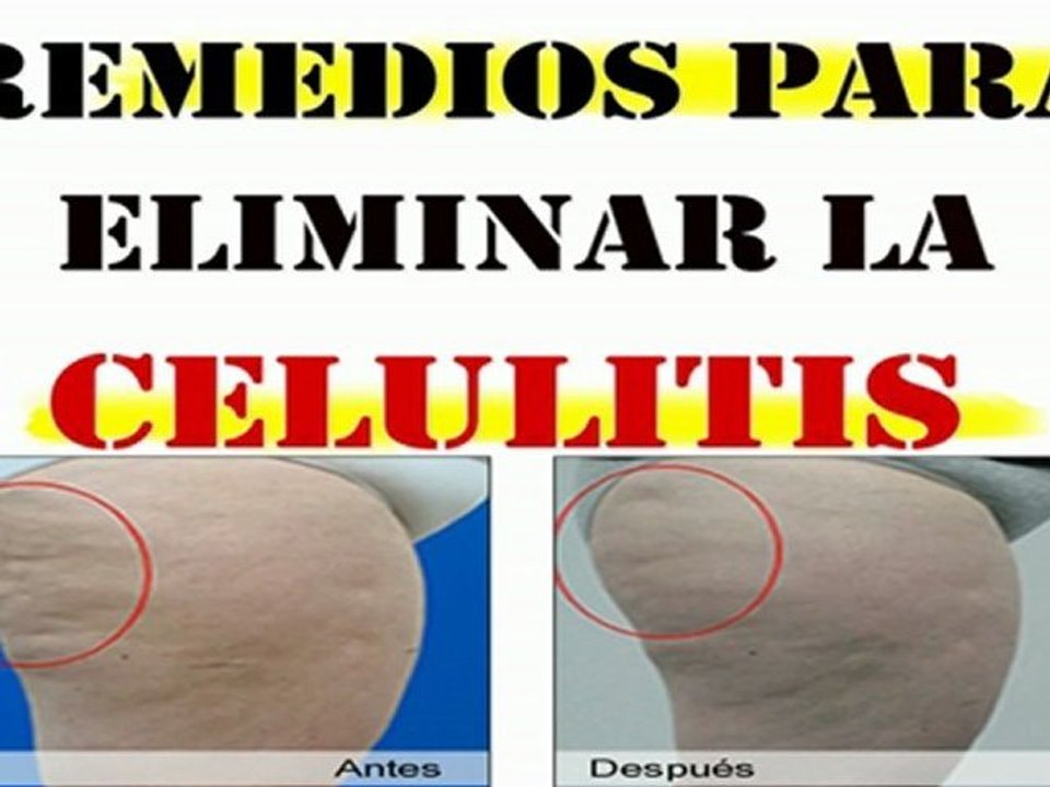 COMO ELIMINAR LA CELULITIS- Remedios Naturales para eliminar la celulitis