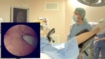 Stérilisation hystéroscopique sans anesthésie